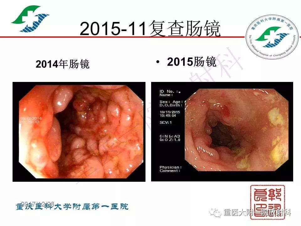 影像PPT - 【PPT】肠道炎性病变的影像诊断-46