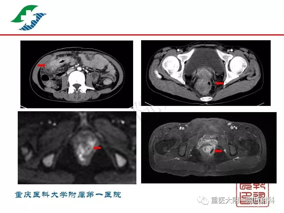 影像PPT - 【PPT】肠道炎性病变的影像诊断-48
