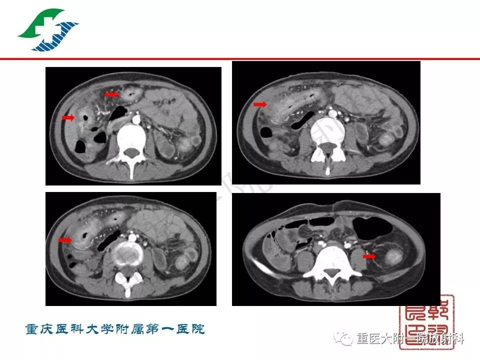 影像PPT - 【PPT】肠道炎性病变的影像诊断-47