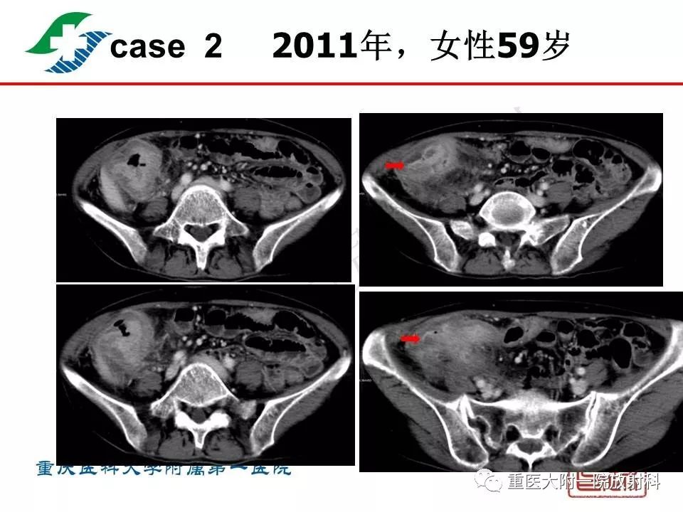 影像PPT - 【PPT】肠道炎性病变的影像诊断-49