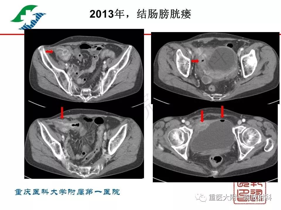 影像PPT - 【PPT】肠道炎性病变的影像诊断-50