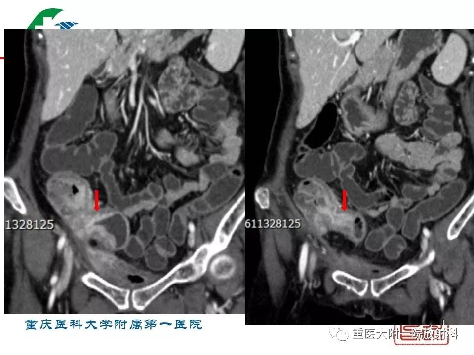影像PPT - 【PPT】肠道炎性病变的影像诊断-52