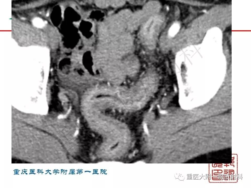 影像PPT - 【PPT】肠道炎性病变的影像诊断-56