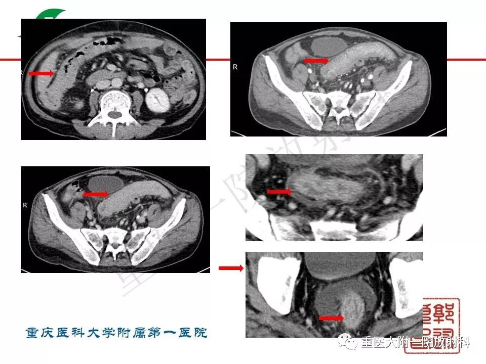影像PPT - 【PPT】肠道炎性病变的影像诊断-57