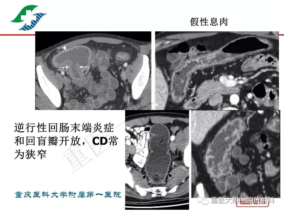 影像PPT - 【PPT】肠道炎性病变的影像诊断-58