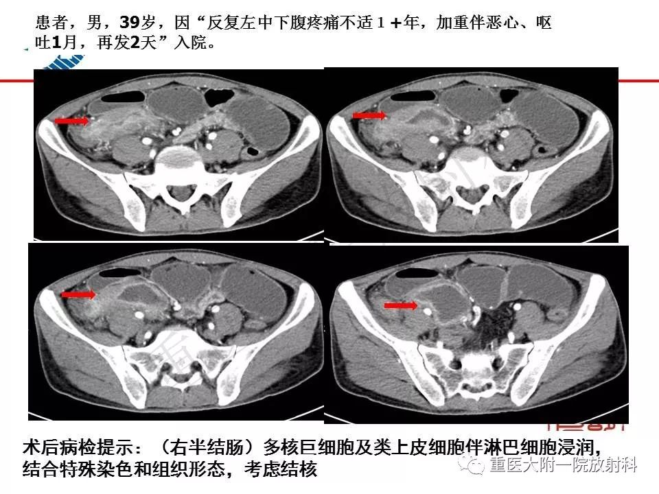 影像PPT - 【PPT】肠道炎性病变的影像诊断-61