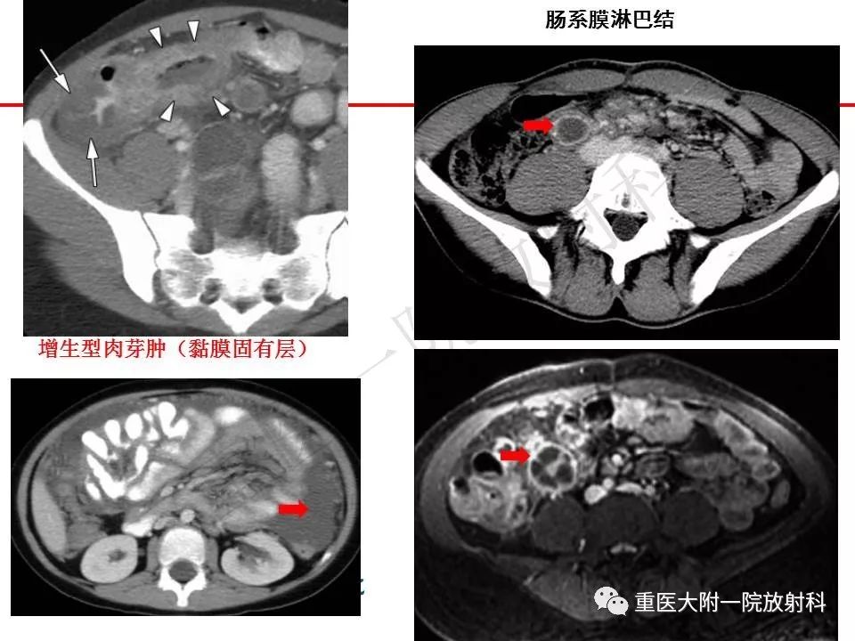 影像PPT - 【PPT】肠道炎性病变的影像诊断-62