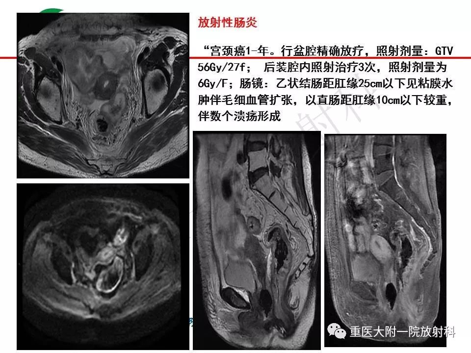 影像PPT - 【PPT】肠道炎性病变的影像诊断-64