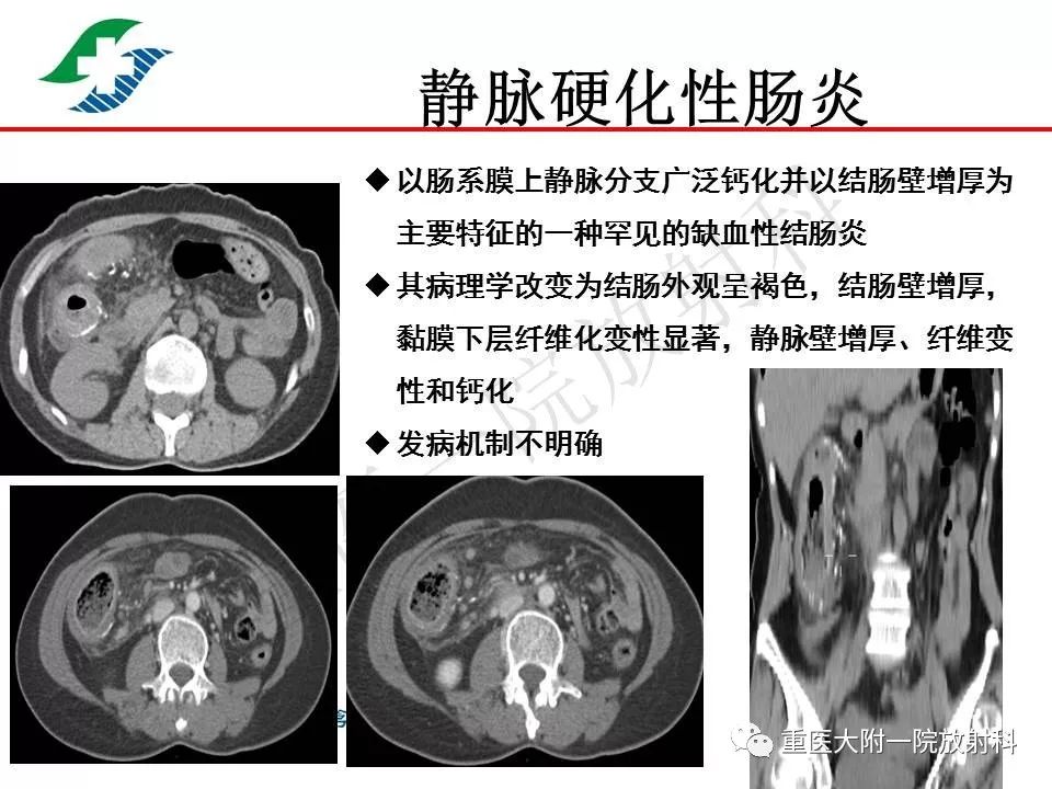 影像PPT - 【PPT】肠道炎性病变的影像诊断-65