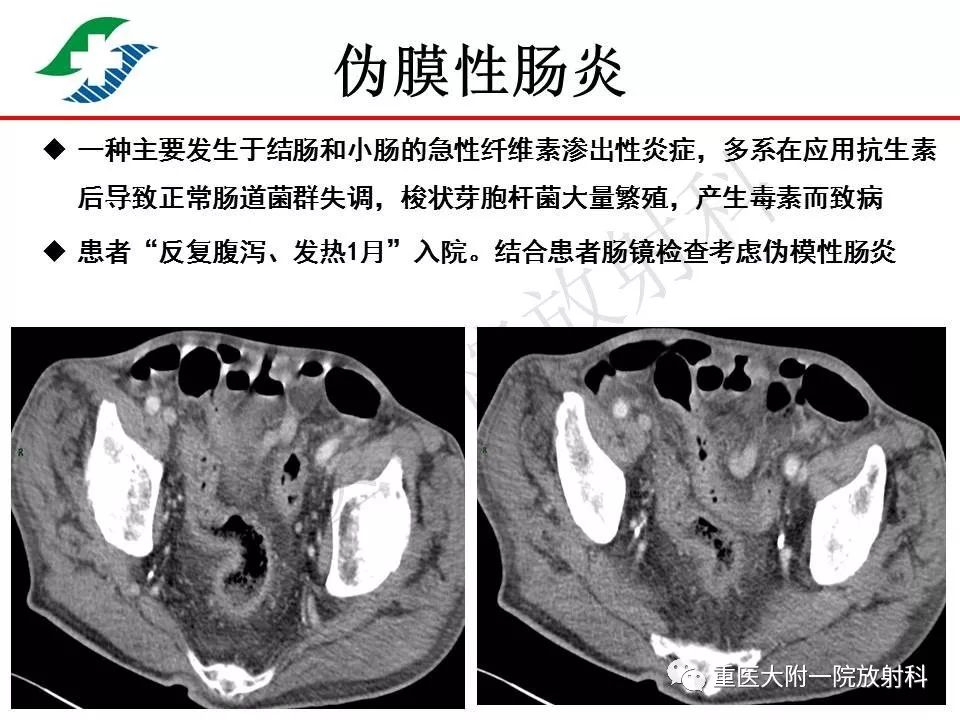 影像PPT - 【PPT】肠道炎性病变的影像诊断-66