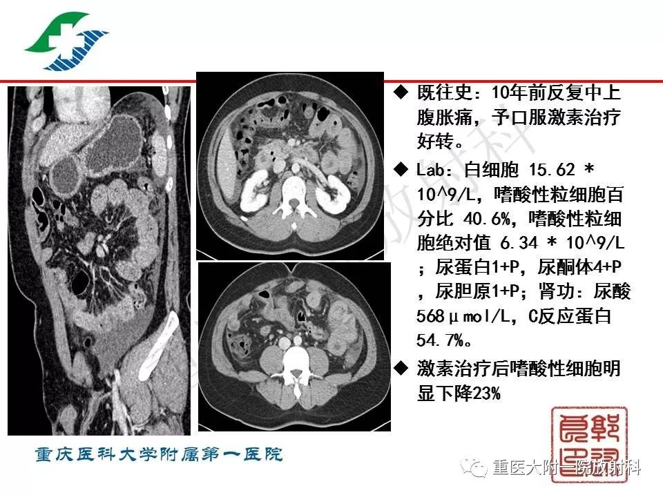 影像PPT - 【PPT】肠道炎性病变的影像诊断-68