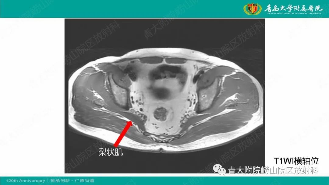 影像PPT - 【PPT】MR成像在梨状肌综合征诊治中的价值-7