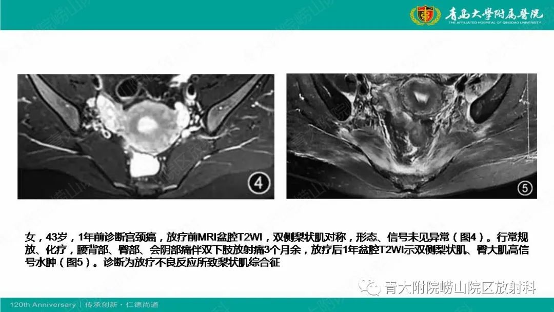 影像PPT - 【PPT】MR成像在梨状肌综合征诊治中的价值-16