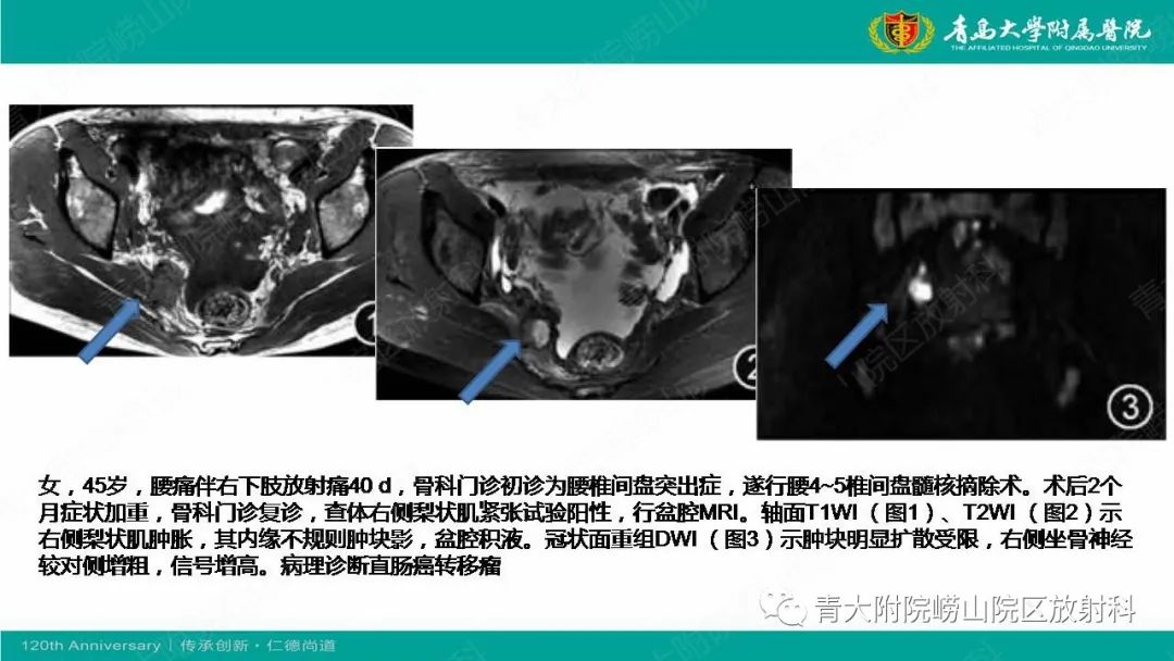 影像PPT - 【PPT】MR成像在梨状肌综合征诊治中的价值-15
