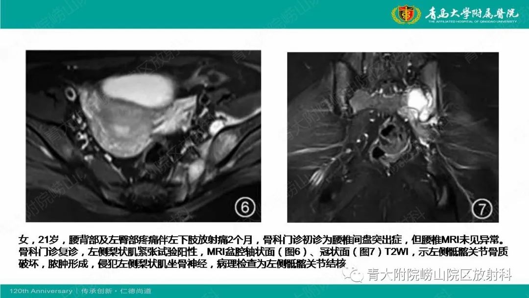 影像PPT - 【PPT】MR成像在梨状肌综合征诊治中的价值-20