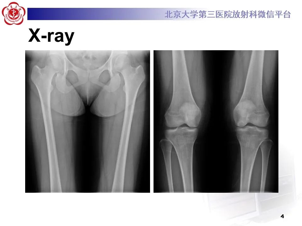 影像PPT - 【PPT】骨梗死的影像-3