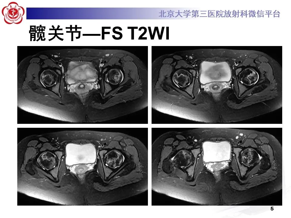 影像PPT - 【PPT】骨梗死的影像-4