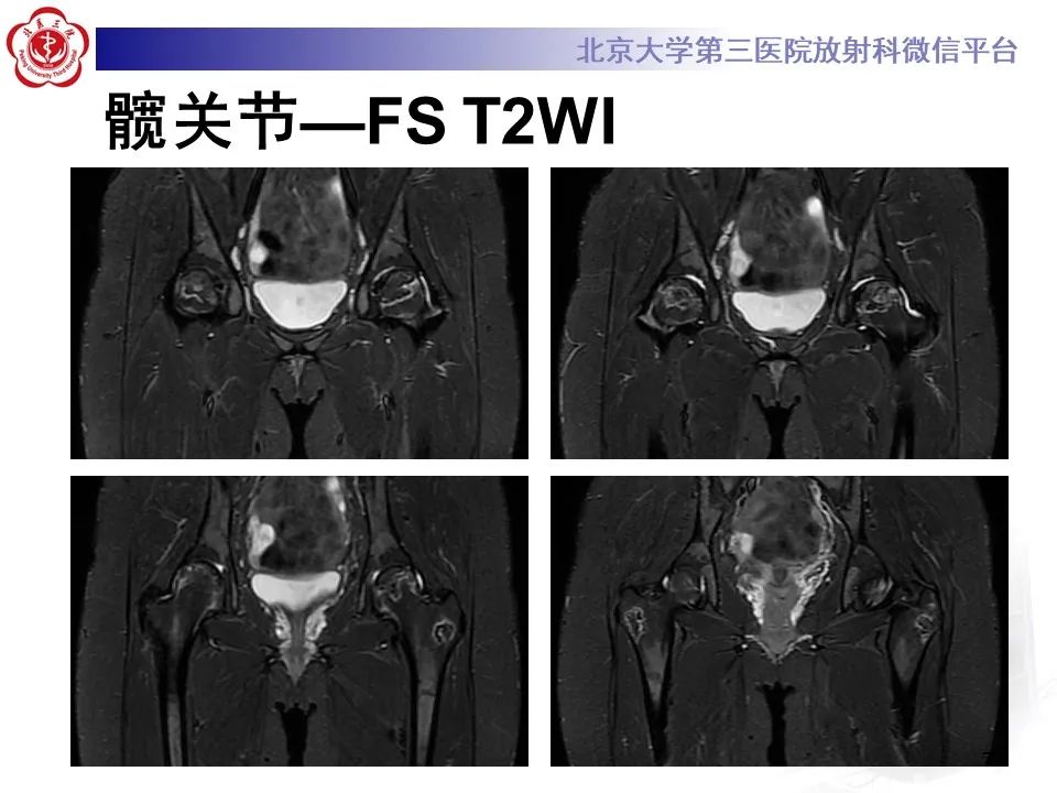 影像PPT - 【PPT】骨梗死的影像-6