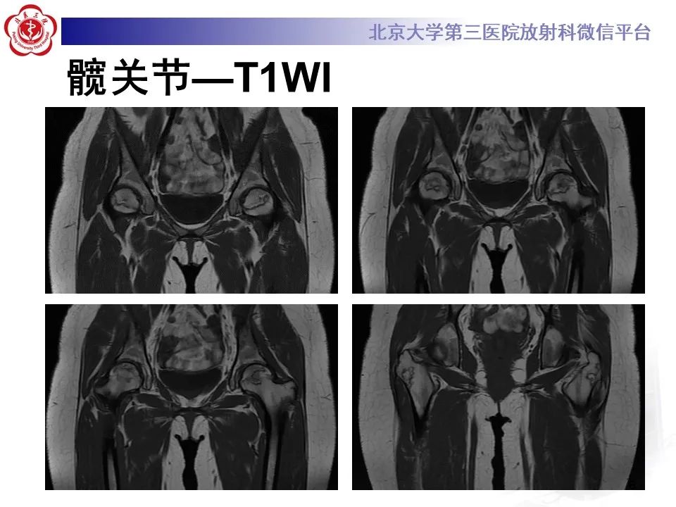影像PPT - 【PPT】骨梗死的影像-5