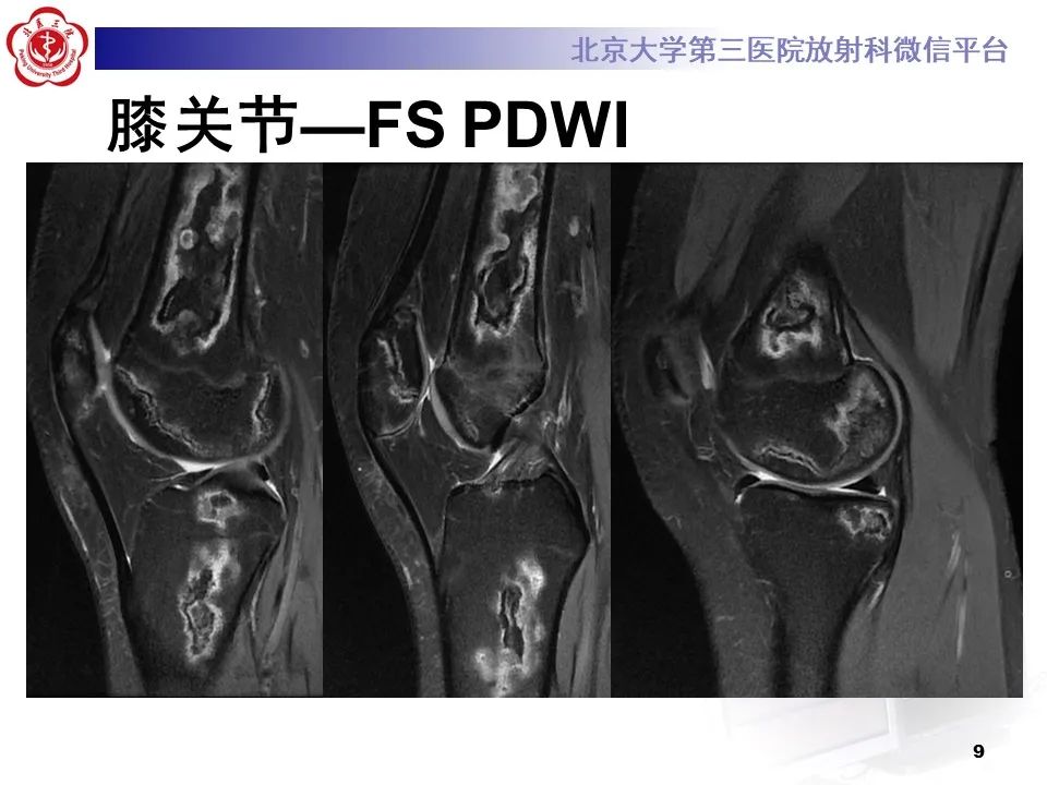 影像PPT - 【PPT】骨梗死的影像-8