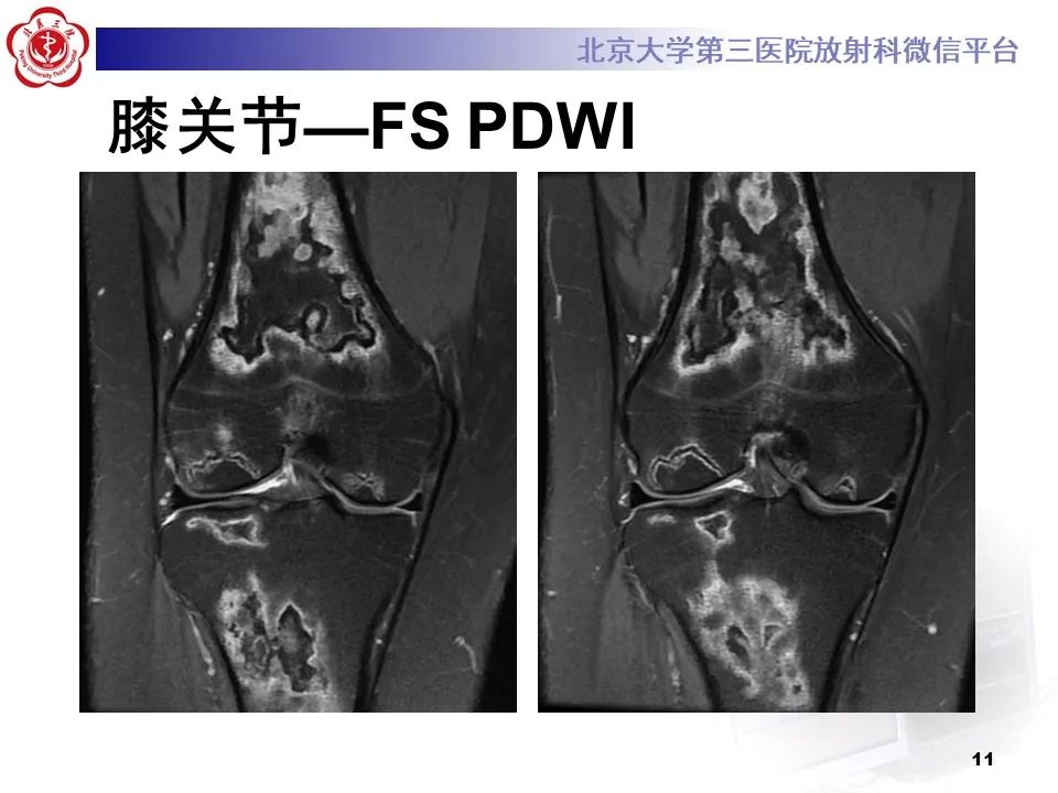 影像PPT - 【PPT】骨梗死的影像-10