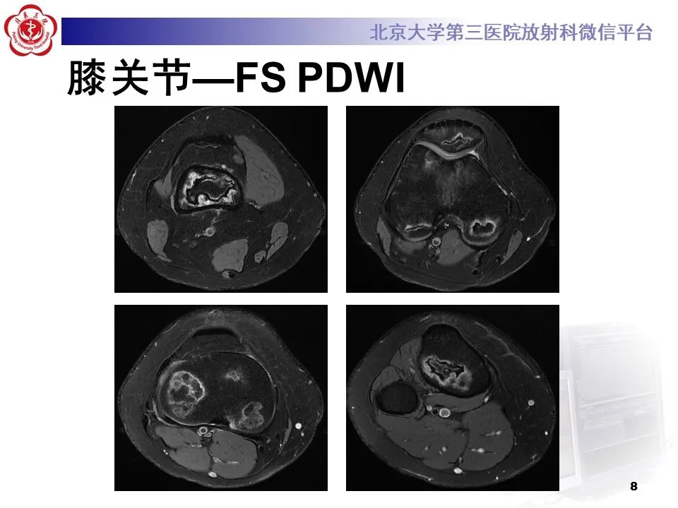 影像PPT - 【PPT】骨梗死的影像-7