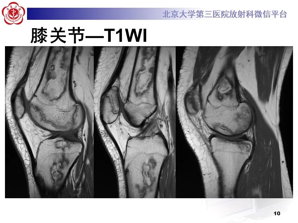 影像PPT - 【PPT】骨梗死的影像-9