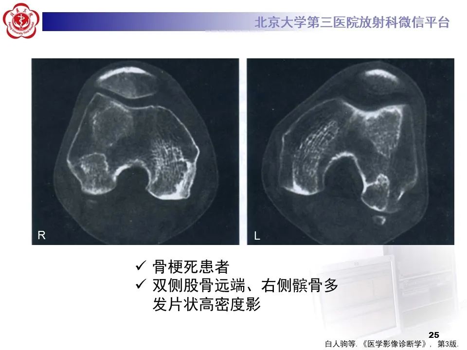 影像PPT - 【PPT】骨梗死的影像-24