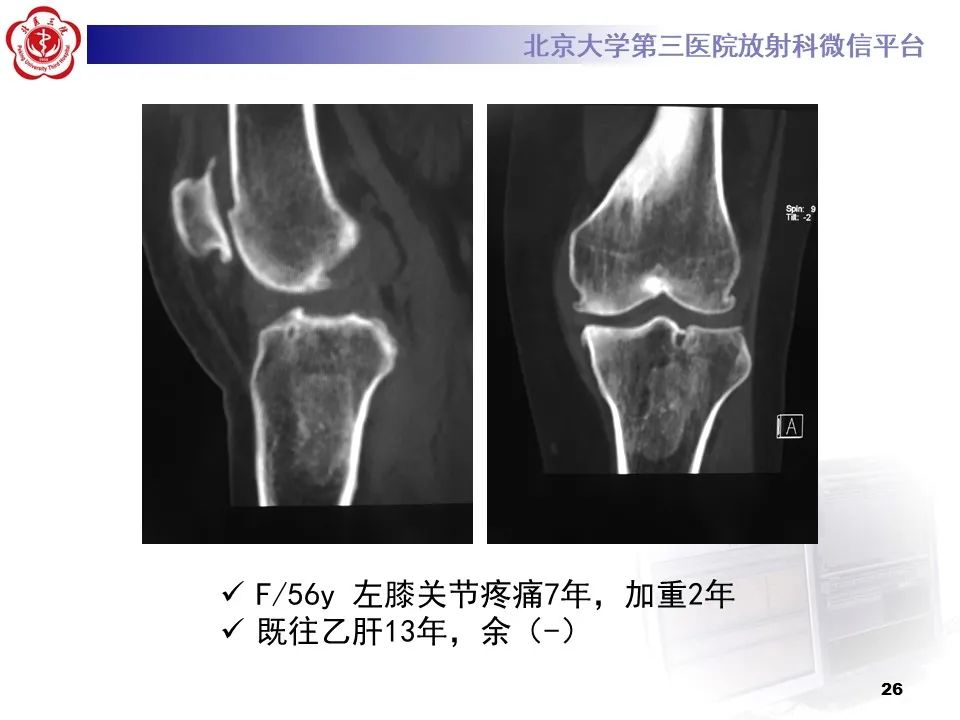 影像PPT - 【PPT】骨梗死的影像-25