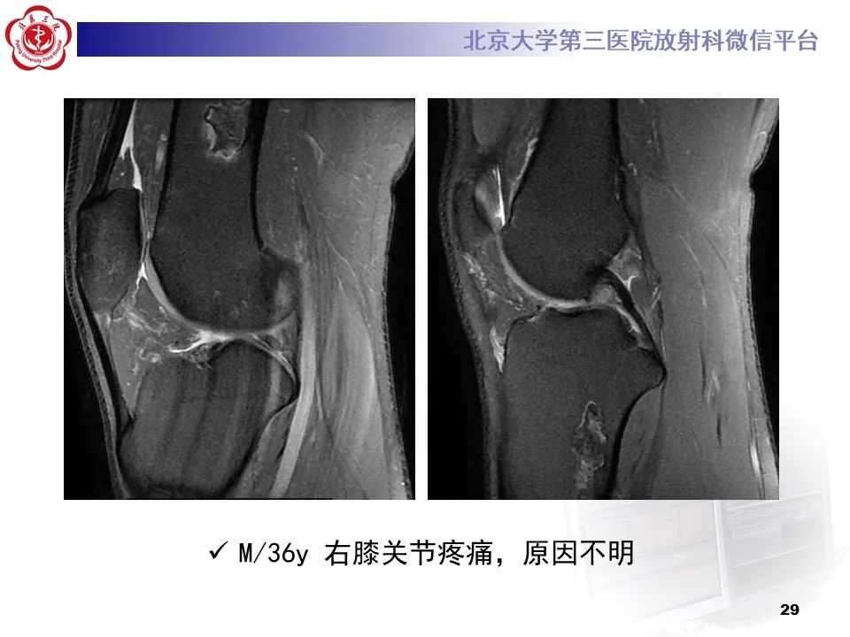 影像PPT - 【PPT】骨梗死的影像-28
