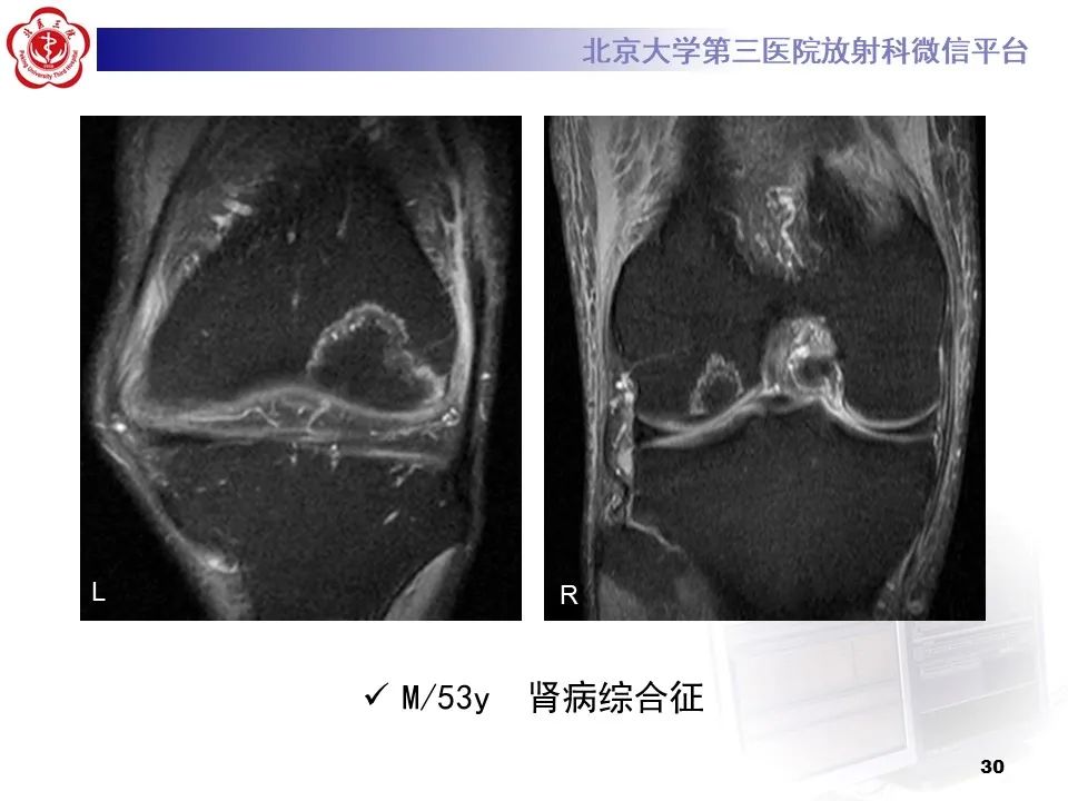 影像PPT - 【PPT】骨梗死的影像-29