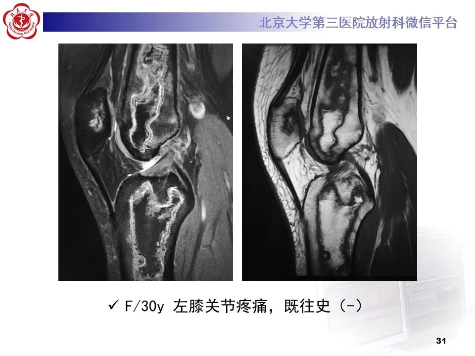 影像PPT - 【PPT】骨梗死的影像-30