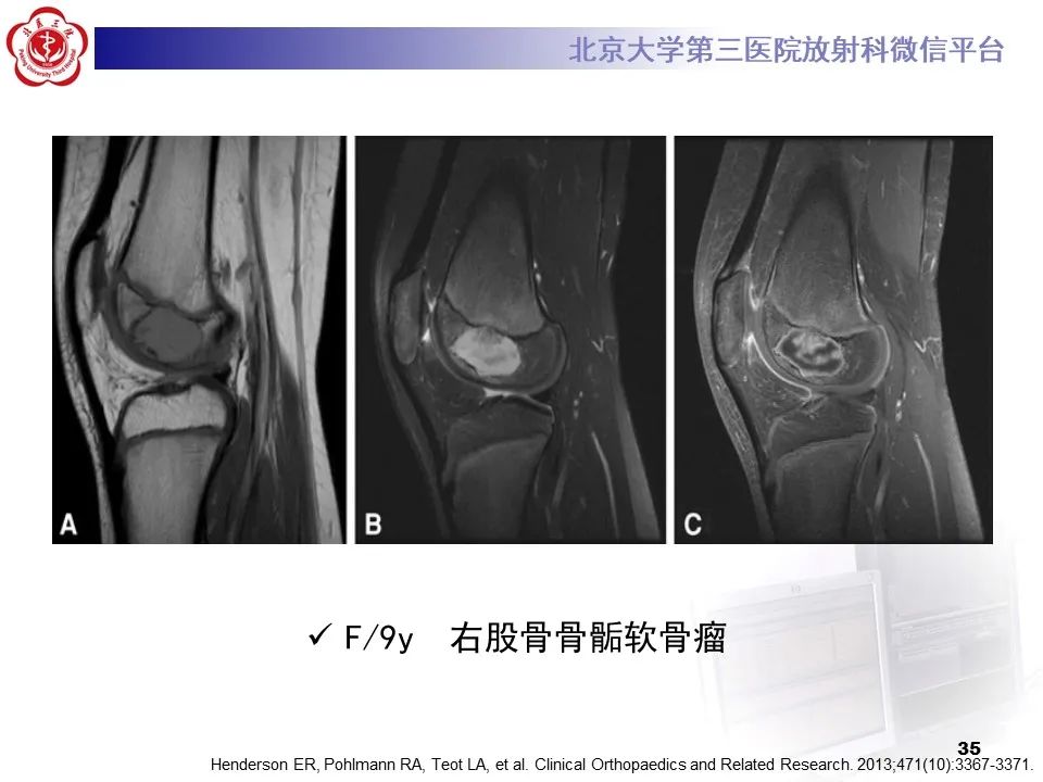 影像PPT - 【PPT】骨梗死的影像-34