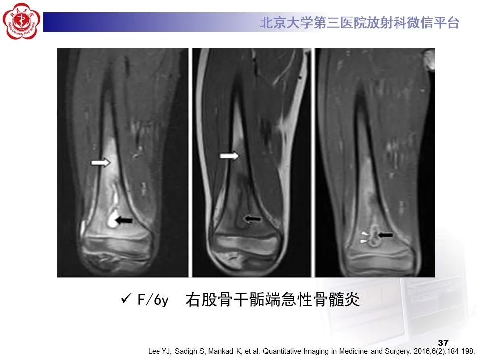 影像PPT - 【PPT】骨梗死的影像-36
