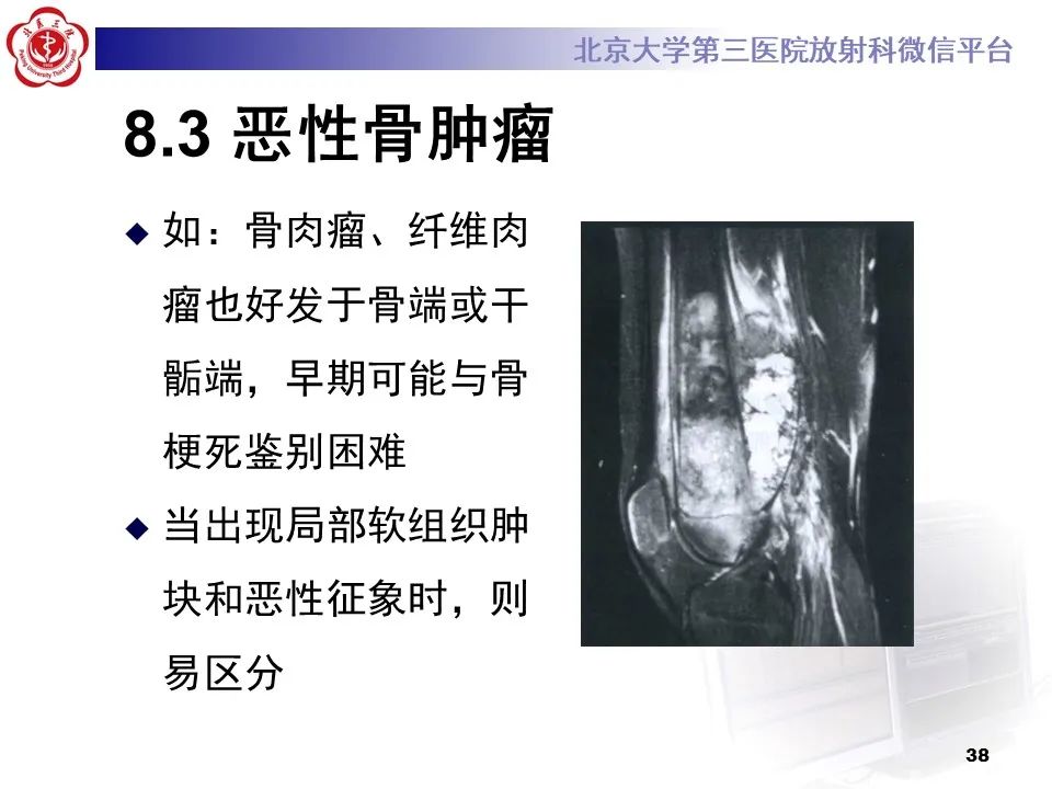 影像PPT - 【PPT】骨梗死的影像-37