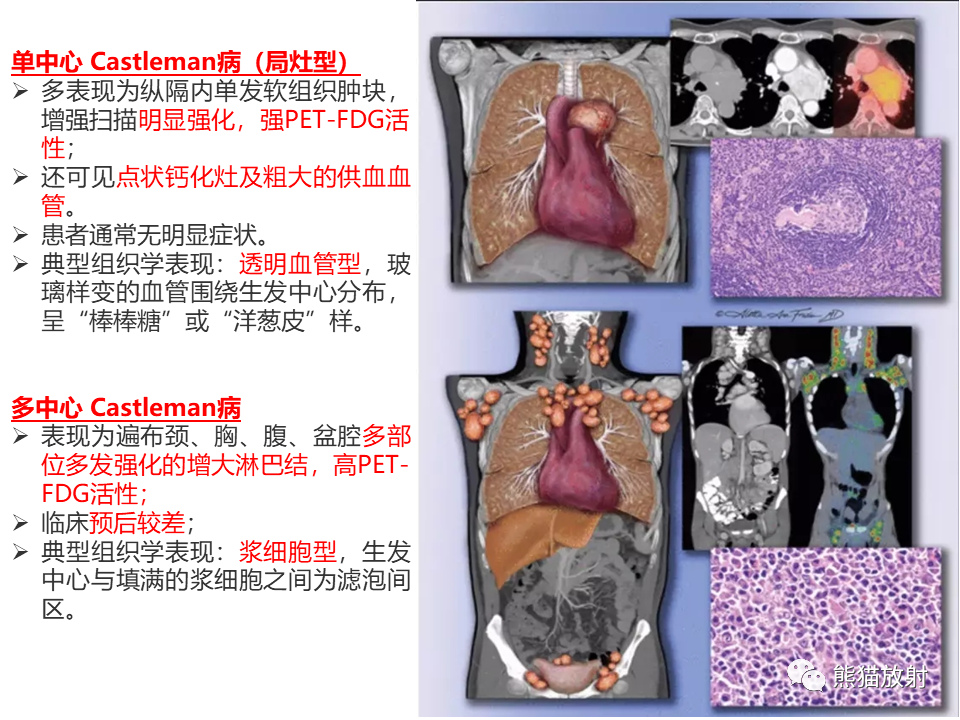 影像PPT - 【病例】腹膜后Castleman病VS副神经节瘤-30