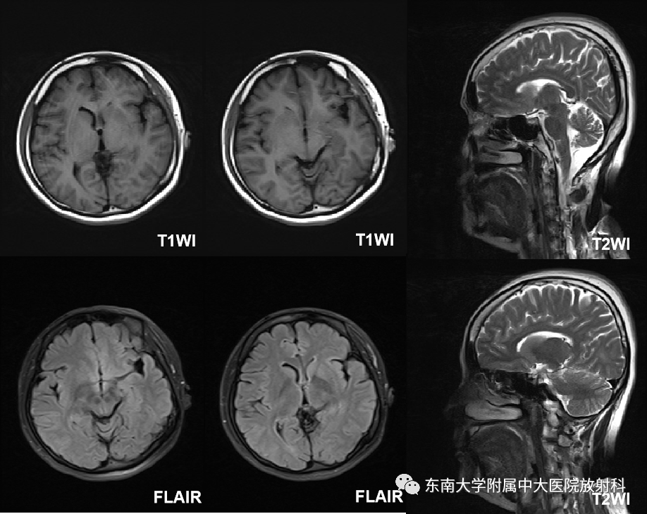 影像PPT - 【PPT】肝豆状核变性-1