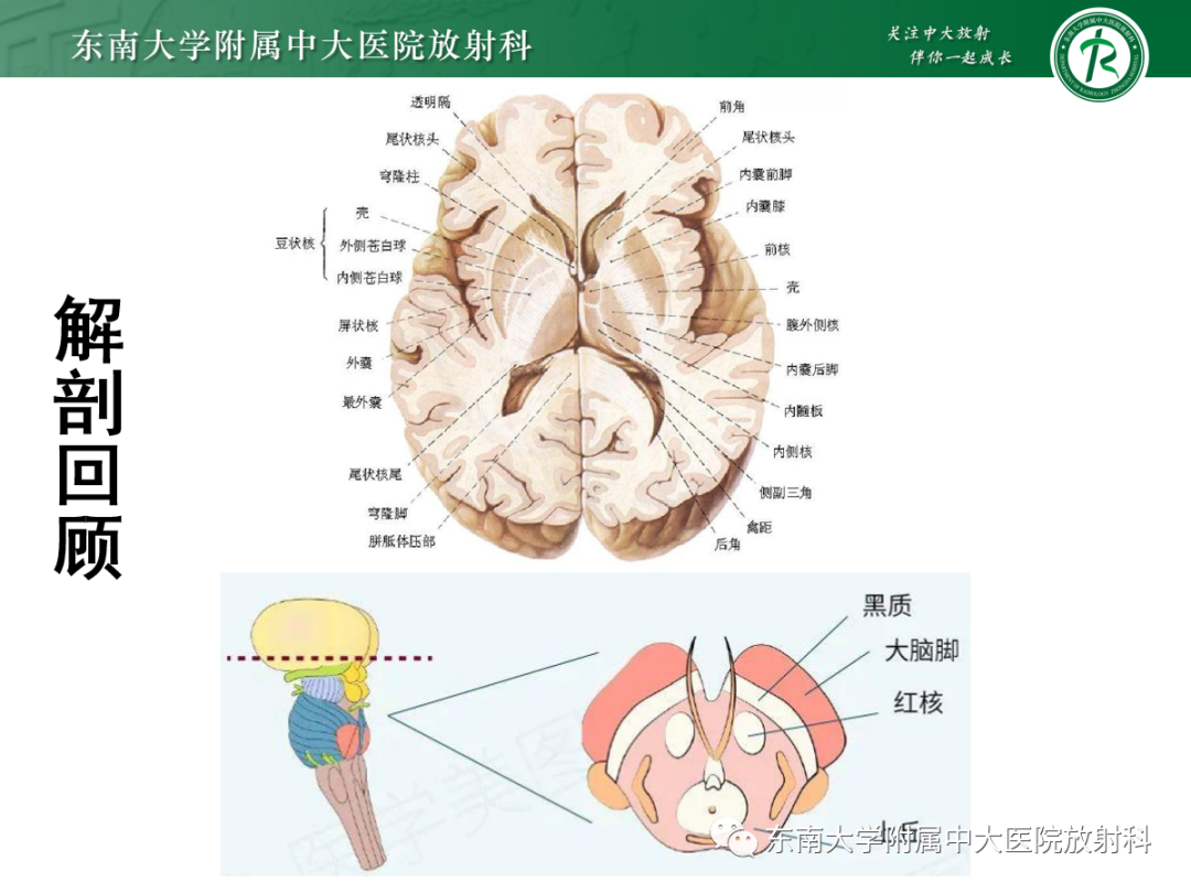 影像PPT - 【PPT】肝豆状核变性-8