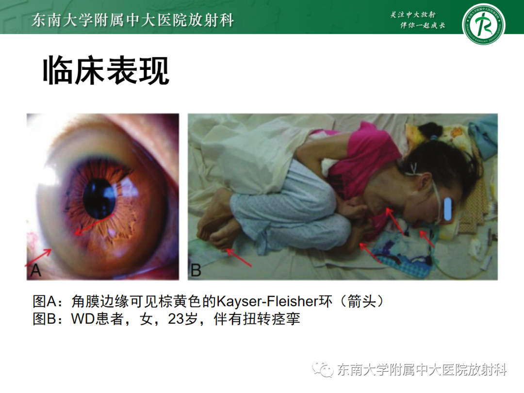 影像PPT - 【PPT】肝豆状核变性-10