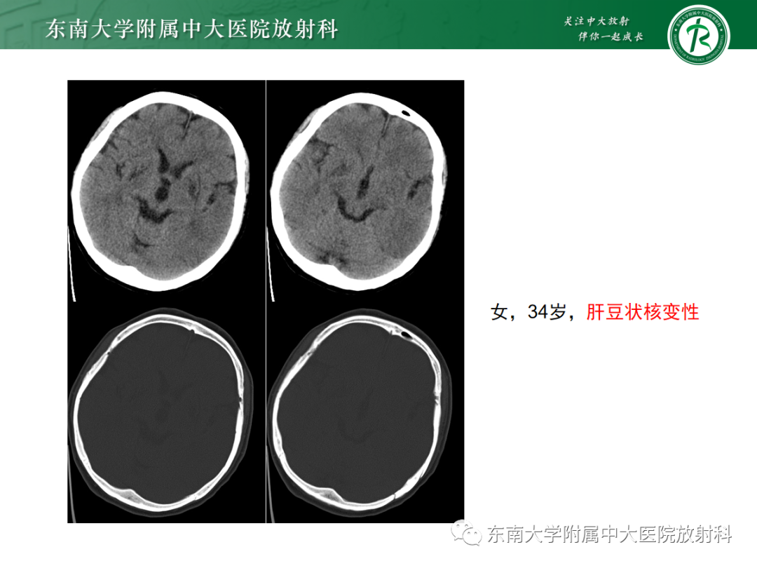 影像PPT - 【PPT】肝豆状核变性-15