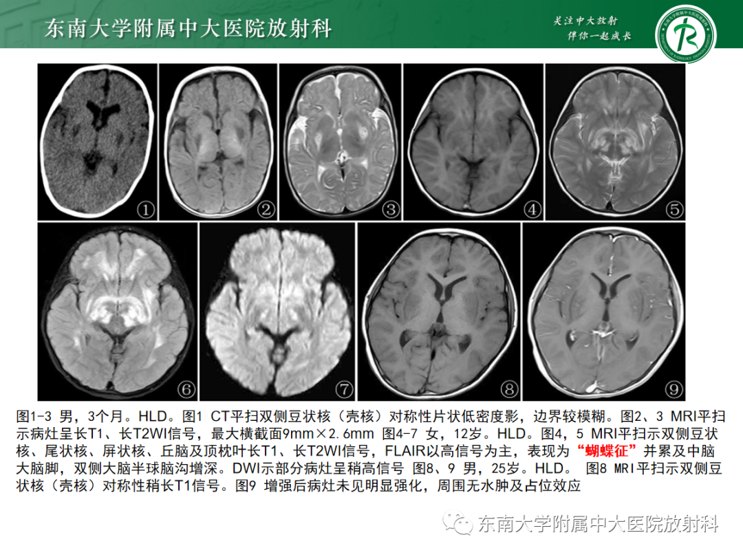 影像PPT - 【PPT】肝豆状核变性-18