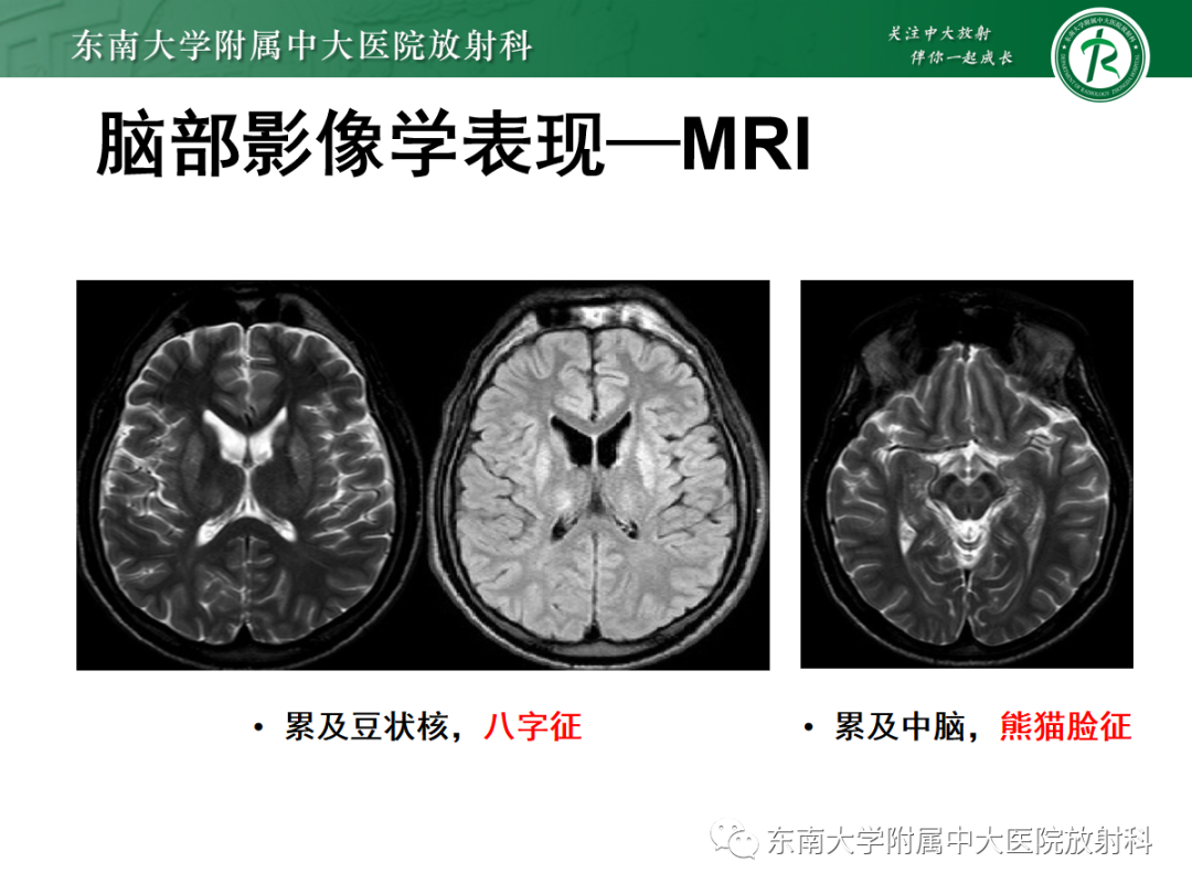 影像PPT - 【PPT】肝豆状核变性-17