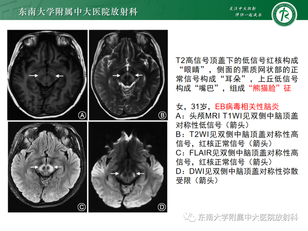 影像PPT - 【PPT】肝豆状核变性-23