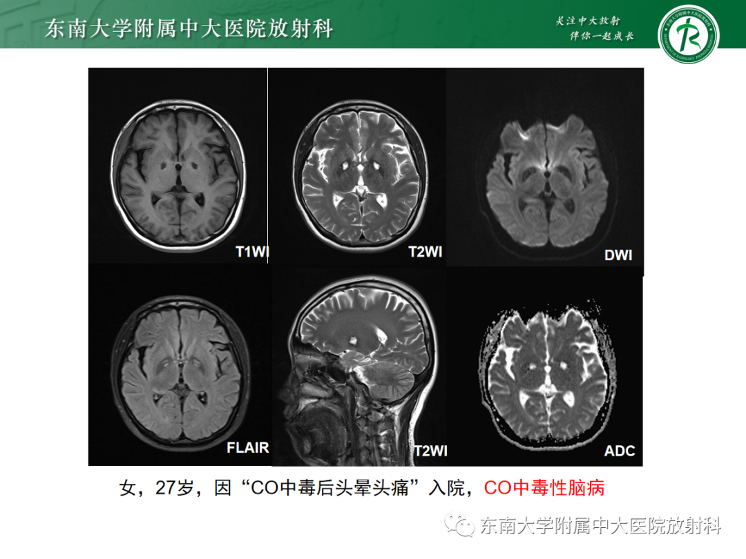 影像PPT - 【PPT】肝豆状核变性-21