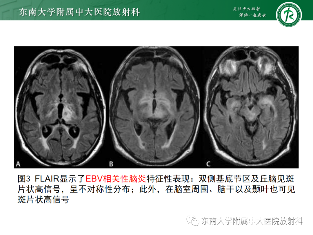 影像PPT - 【PPT】肝豆状核变性-24