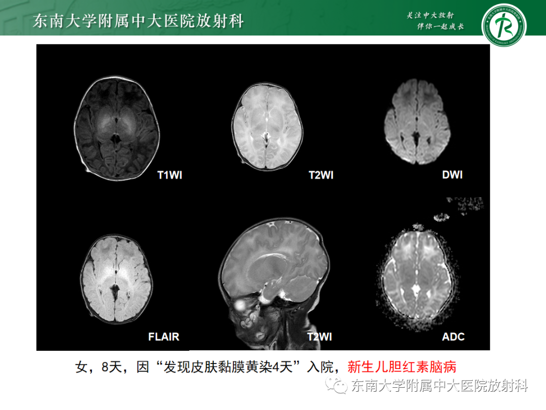 影像PPT - 【PPT】肝豆状核变性-26