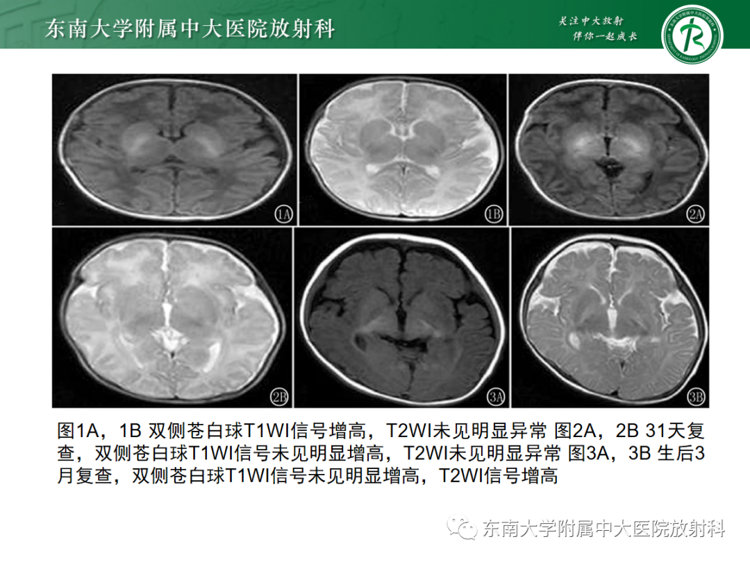 影像PPT - 【PPT】肝豆状核变性-27