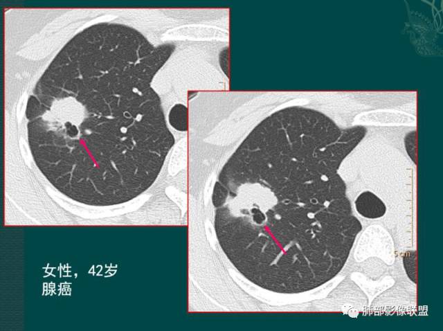 影像PPT - 肺部影像病理——鼻涕泡-1