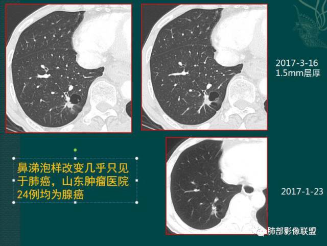 影像PPT - 肺部影像病理——鼻涕泡-3