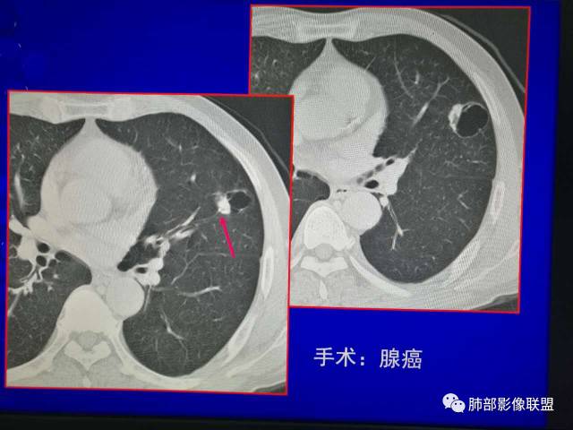 影像PPT - 肺部影像病理——鼻涕泡-4